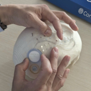 Zwei Männerhände zeigen an einem Schädel den Sitz den Implantats.