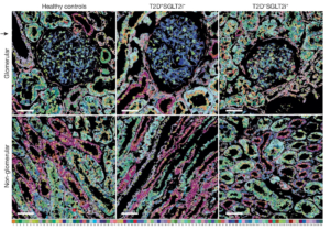 Mit PathoPlex lassen sich Veränderungen von über 100 Proteinmarkern gleichzeitig untersuchen – etwa bei Nierenerkrankungen.