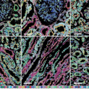 Mit PathoPlex lassen sich Veränderungen von über 100 Proteinmarkern gleichzeitig untersuchen – etwa bei Nierenerkrankungen.