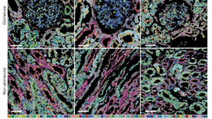 Mit PathoPlex lassen sich Veränderungen von über 100 Proteinmarkern gleichzeitig untersuchen – etwa bei Nierenerkrankungen.