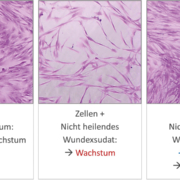 Funktioneller Bioassay: Wundexsudat (Wundflüssigkeit) aus chronischen Wunden schädigt und tötet menschliche Zellen. Der Wirkstoff AKR101 stellt normales Zellwachstum wieder her.