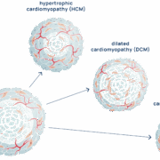 Die Cardioids von Heartbeat.Bio ahmen die strukturellen und molekularen Defekte nach – wie etwa Kammererweiterung, verringerte Größe und fibrofettigen Ersatz von Herzmuskelzellen –, die bei verschiedenen Formen erblicher Kardiomyopathien vorkommen.