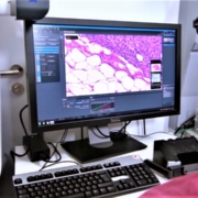 Tumorgewebeanalyse bei BioNTech zur individuellen Anpassung einer Therapie (iNeST)