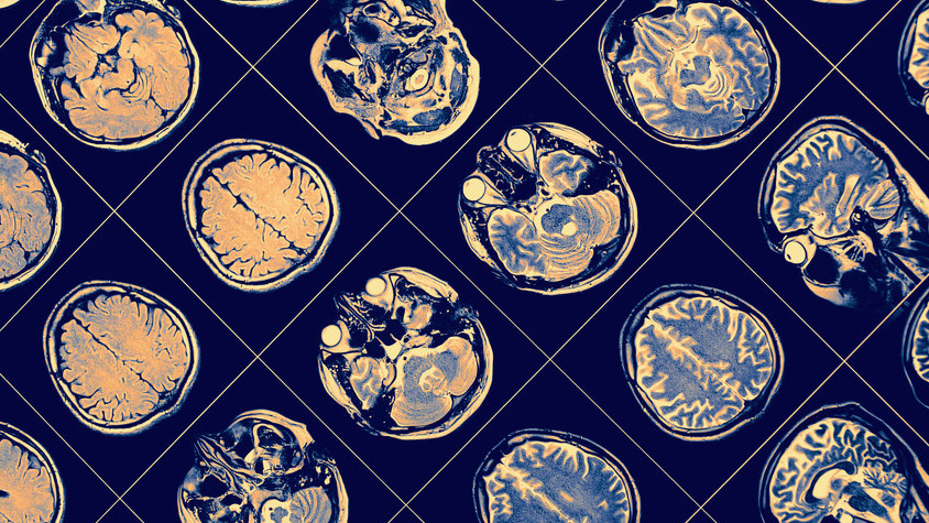 mtz.de_Alzheimer_EU-Initiative_ACCESS_AD