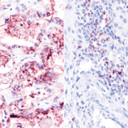 Automatisierte Erkennung von PPIs auf Leica BOND RX/RXm in verschiedenen krebsartigen FFPE-Geweben mit NaveniBright BOND RX. Links: Nachweis von Mucin16/Mesothelin in Eierstockkrebsgewebe. Rechts: Nachweis von PD1/PD-L1 in Kopf-Hals-Krebsgewebe.