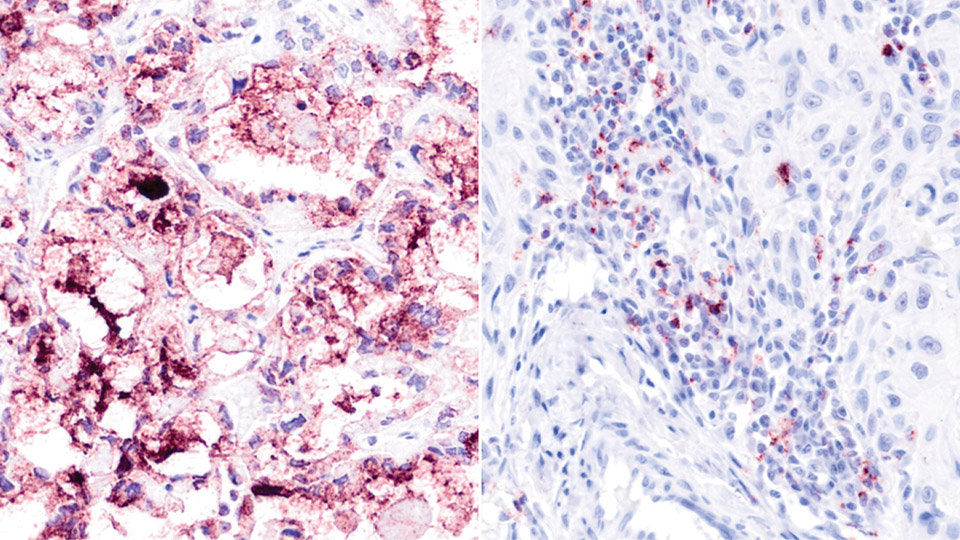 Automatisierte Erkennung von PPIs auf Leica BOND RX/RXm in verschiedenen krebsartigen FFPE-Geweben mit NaveniBright BOND RX. Links: Nachweis von Mucin16/Mesothelin in Eierstockkrebsgewebe. Rechts: Nachweis von PD1/PD-L1 in Kopf-Hals-Krebsgewebe.