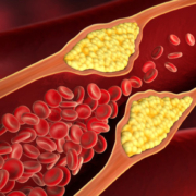 mtz.de_Blutgefaeß_mit_Verengung