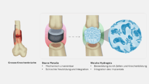 Um Knochen zu verbinden, werden derzeit harte steife Implantate verwendet (l.). Künftig könnten weiche Implantate aus einem Hydrogel eingesetzt werden.