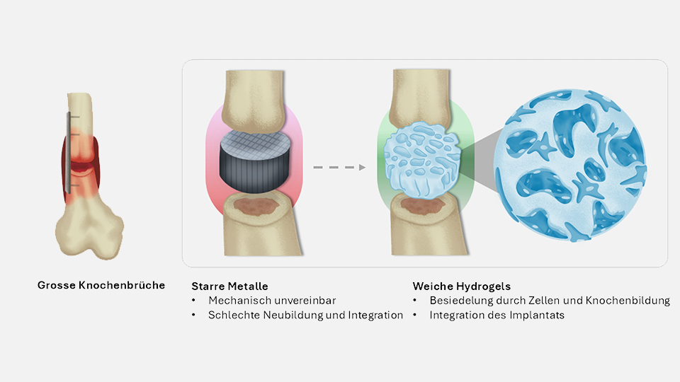 Um Knochen zu verbinden, werden derzeit harte steife Implantate verwendet (l.). Künftig könnten weiche Implantate aus einem Hydrogel eingesetzt werden.