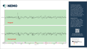 Exemplarische Darstellung eines originalen (oben) und anonymisierten (unten) EEG-Signals aus einer Veröffentlichung im Rahmen des Projekts NEMO
