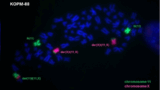 Fluoreszenz-Aufnahme der Chromosomen von Zelllinie KOPM-88. Die Chromosomen 11 und X sind spezifisch angefärbt
und lassen die Fusion beider Chromosomen als „Derivate“ der (11) und der (X) erkennen, wo sich das Fusionsgen
KMT2A::SEPTIN6 befindet.
