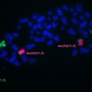 Fluoreszenz-Aufnahme der Chromosomen von Zelllinie KOPM-88. Die Chromosomen 11 und X sind spezifisch angefärbt
und lassen die Fusion beider Chromosomen als „Derivate“ der (11) und der (X) erkennen, wo sich das Fusionsgen
KMT2A::SEPTIN6 befindet.