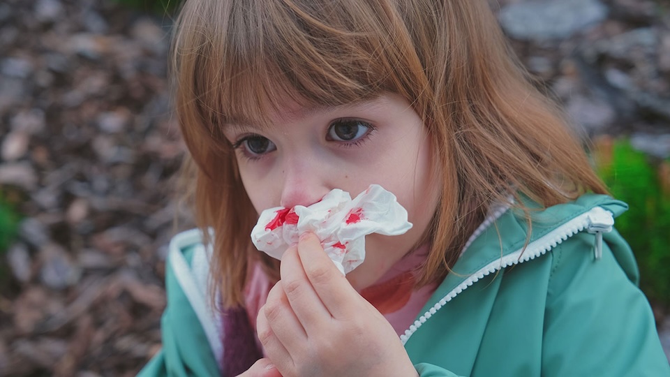 cdc_commons_nose-bleed Millionen gegen Nasenbluten? Wenn es chronisch ist und auch andere Organe von der Veränderung der Blutgefäße betroffen sind, können sich schwerwiegende Krankheiten daraus entwickeln